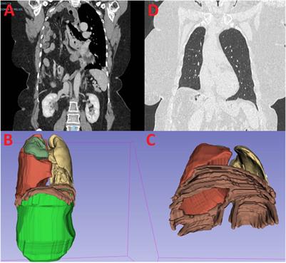 Area of Focus in 3D Volumetry and Botulinum Toxin A Injection for Giant Diaphragmatic Hernia with Loss of Domain: A Case Report with Video Illustration